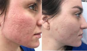 Treatment Options for Acne Scars