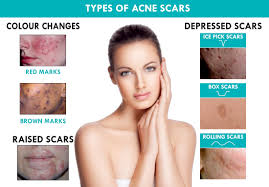 Types and Categories of Acne Scars