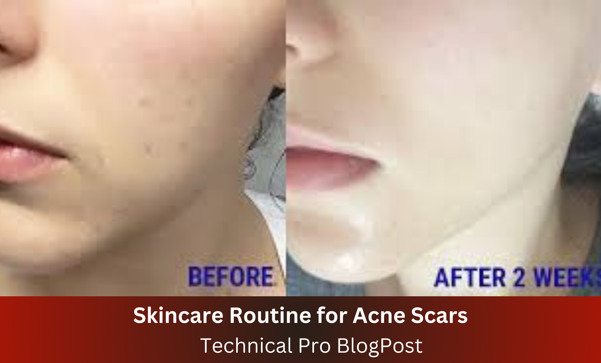 Skincare Routine for Acne Scars